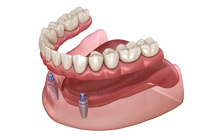 インプラント義歯（自由診療）