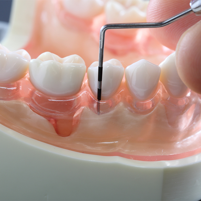 歯周病（再生療法：リグロス）