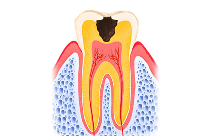 象牙質まで達したむし歯(C2)