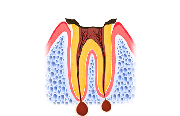 歯の根に達したむし歯(C4)