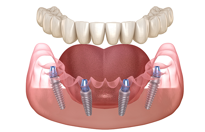 多くの歯を失った場合のインプラント治療