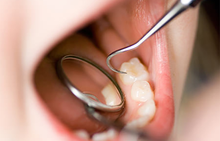 子どものむし歯の特徴