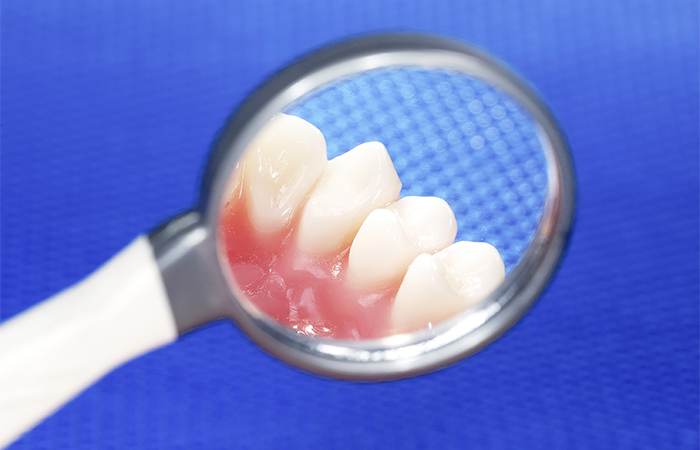 歯周組織再生治療（リグロスによる再生治療）